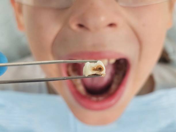 Best Emergency Dental Care for Broken or Chipped Teeth in Cle Elum, WA